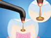 虫歯検査器による触診イメージ